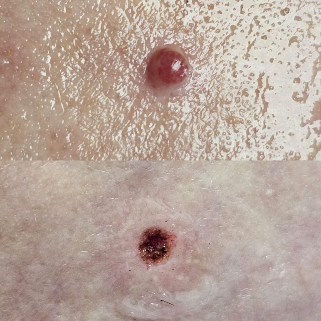 Cherry Angioma- before and immediately after removal