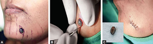 Image retrieved from Procedural Dermatosurgery—A Step by Step Approach by C Madura and KR Pushpa